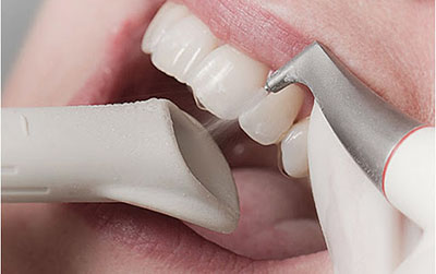  Гигиена, профилактика и чистка зубов